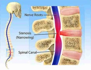 Spinal canal Root Back Pian