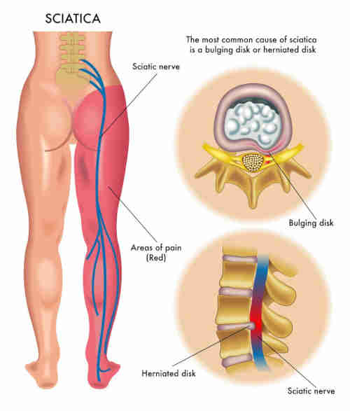 Back Pain Sciatica