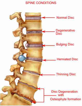 Back spinal condition